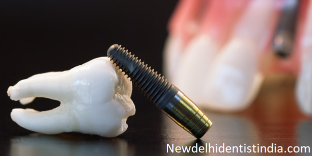 success rate of dental implants
